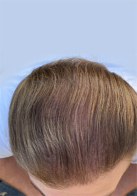 hair transplant photos