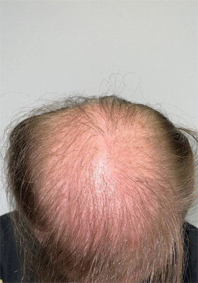 hair transplant photos