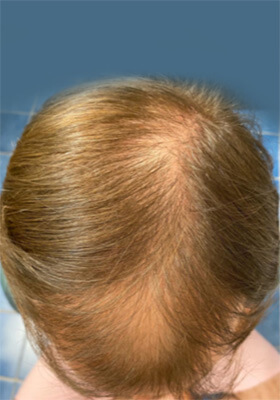 hair transplant photos