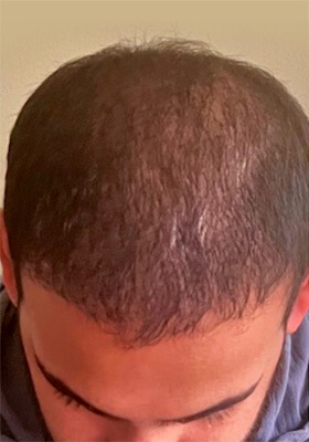 hair transplant before after Photos