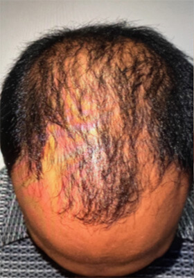 hair transplant before after Photos