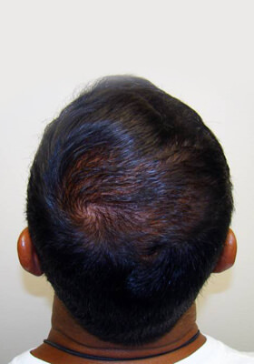 hair transplant before after Photos