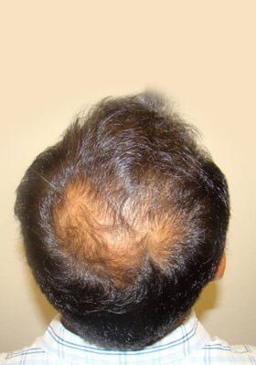 hair transplant before after Photos