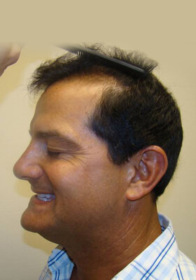 hair transplant photos