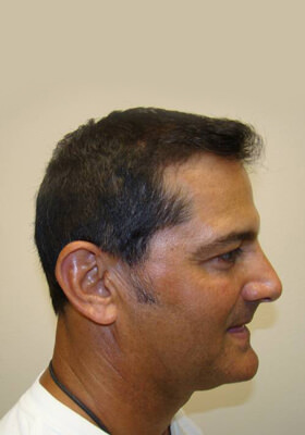 hair transplant before after Photos