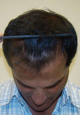 hair transplant before after Photos