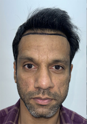 hair transplant photos