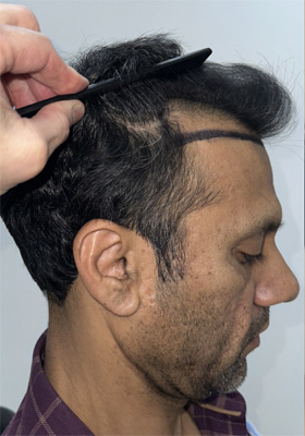 hair transplant before after Photos