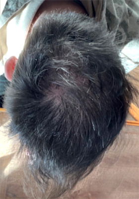 hair transplant before after Photos