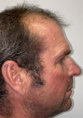 hair transplant photos