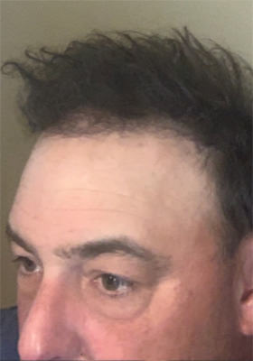 hair transplant photos