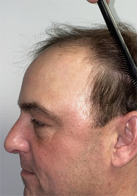 hair transplant before after Photos