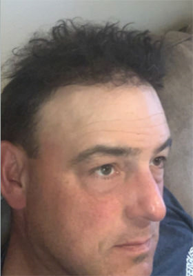 hair transplant photos