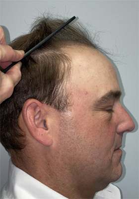 hair transplant photos