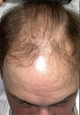 hair transplant before after Photos