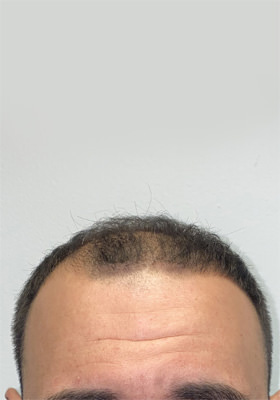 hair transplant before after Photos