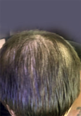 hair transplant before after Photos