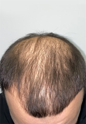 hair transplant photos