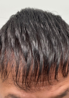 hair transplant before after Photos