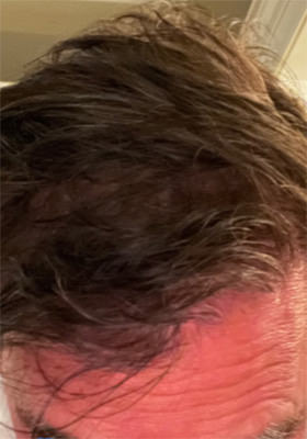 hair transplant before after Photos