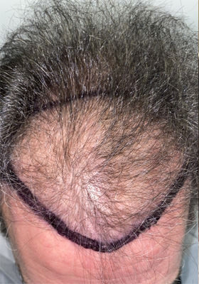 hair transplant photos