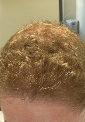 hair transplant before after Photos