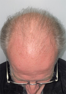 hair transplant photos