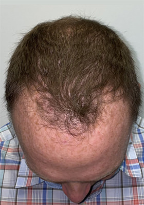 hair transplant photos