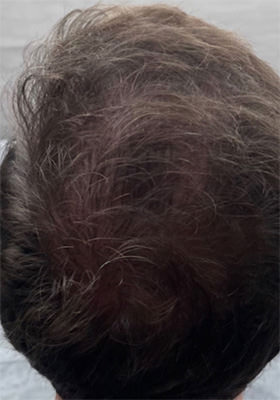 hair transplant photos