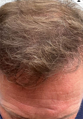 hair transplant photos