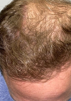 hair transplant photos