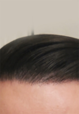 hair transplant before after Photos