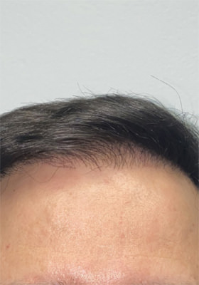 hair transplant photos