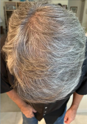 hair transplant photos