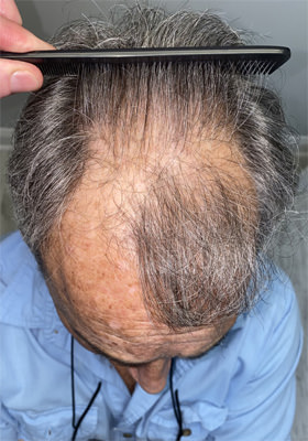 hair transplant before after Photos