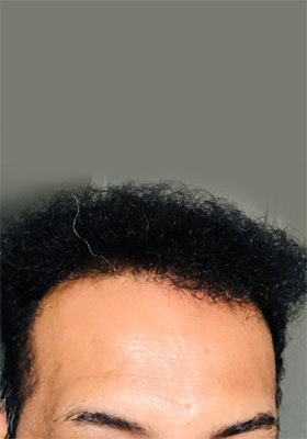 hair transplant photos