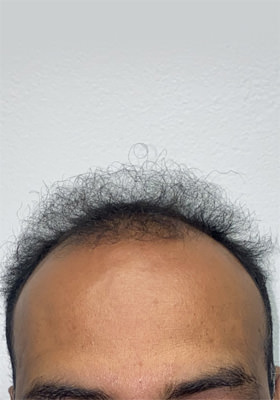 hair transplant before after Photos