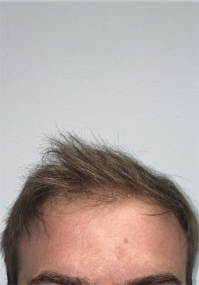 hair transplant photos