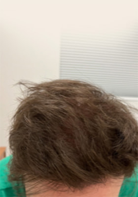 hair transplant before after Photos