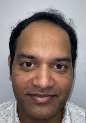 hair transplant before after Photos