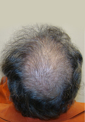 hair transplant before after Photos