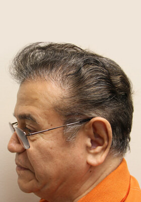 hair transplant before after Photos