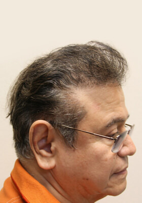 hair transplant photos