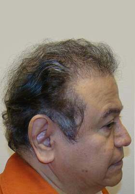 hair transplant photos