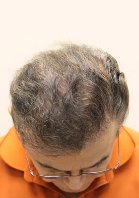 hair transplant photos