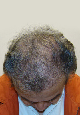hair transplant before after Photos