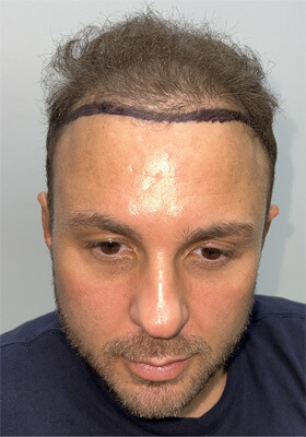 hair transplant before after Photos