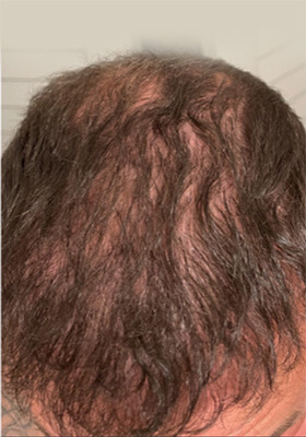 hair transplant photos