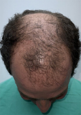 hair transplant photos