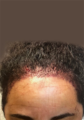 hair transplant photos